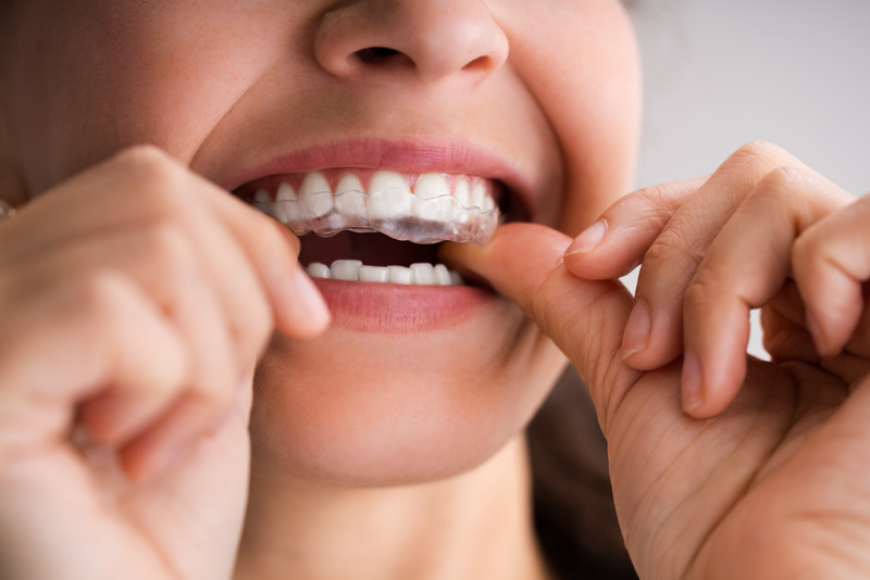 Clear Aligner Dental Night Guard